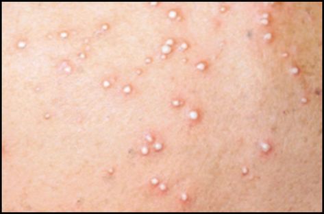 An inflamed papule with white-yellow pus/liquid inside, usually made of white blood cells, bacteria, or other debris. May or may not be infectious. Skin Lesions, Skin Natural Remedies, White Blood, White Blood Cells, Blood Cells, Skin Makeup, Natural Remedies, Disease, Tattoo Quotes