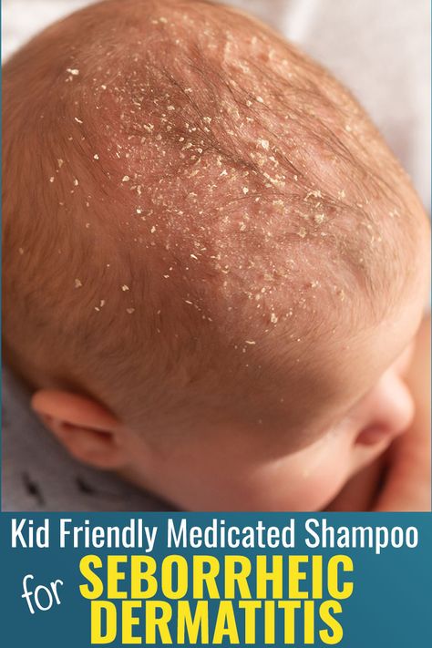 Many people see the picture of this infant and think dandruff, but this is actually called seborrheic dermatitis.  Dr. Eddie’s Happy Cappy shampoo and body wash is a kid friendly medicated shampoo and body wash for relief of skin and scalp itching, irritation, redness, flaking, and scaling associated with seborrheic dermatitis. #SeborrheicDermatitis Get Rid Of Dry Scalp, Happy Cappy, Cradle Cap, Dandruff Shampoo, Beard Growth, Dry Scalp, The Attic, Acid Reflux, Beard Oil