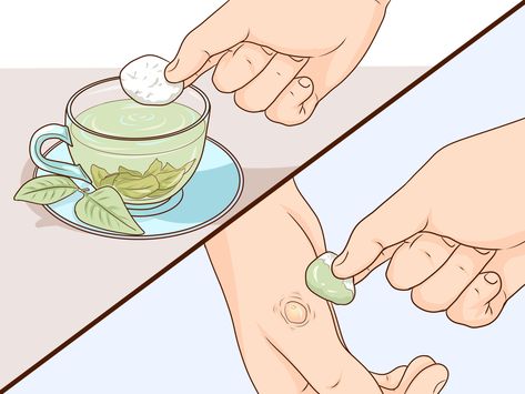 How To Get Rid Of Blisters On Feet Fast, How To Heal Blisters On Feet Fast, Blisters Remedies, Blisters On Hands, Essential Oils For Blisters, How To Treat Blisters, Heal Blisters, Water Blister, Blister Remedies