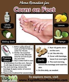 Prev post1 of 3Next Corns are small circles of hard, thickened skin that develop when the skin is exposed to excessive pressure or friction. Corns most often develop on the feet, especially on the tops and sides of the toes, soles of your feet and even between the toes. They can also develop on other Get Rid Of Corns, Corn Removal, Nail Remedies, Lemon Vinegar, Nail Care Diy, Top 10 Home Remedies, Nail Fungus, Nail Health, Foot Care