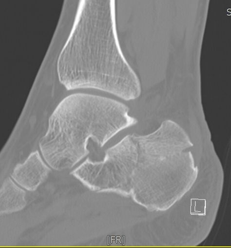 Calcaneus fracture Calcaneus Fracture, Lower Limb, Skin Disorders, Sports Injury, Bones, Massage, Medicine, Technology