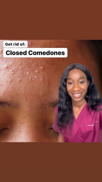 Small Pimples On Face, Skin Bumps On Face, Small Bumps On Face, Closed Comedones, Comedonal Acne, Pimples On Forehead, Acne Hyperpigmentation, Forehead Acne, Bad Acne