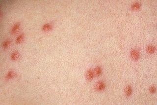 Baby Rashes, Poisonous Spiders, Red Moles, Bug Images, Bad Bugs, Health Tools, Bug Bites, Insect Bites, Paw Print Tattoo