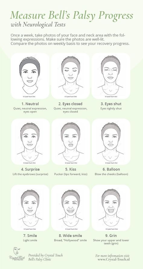 Facial Palsy Exercise, Bells Palsy Facial Exercises, Bell’s Palsy Exercises, Tens Unit Placement, Bell’s Palsy, Nerve Conduction Study, Bells Palsy, Combine Pictures, Acupressure Therapy