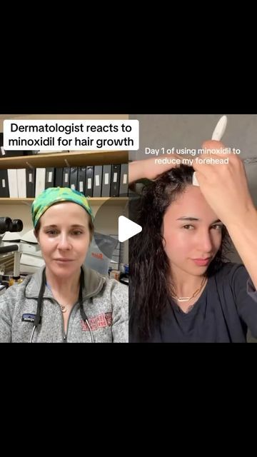 Dr. Abigail Waldman, MD FAAD on Instagram: "Considered trying minoxidil for hair loss? Watch this video first 

Dermatologist reacts to microneedling and minoxidil for hair growth. 

🎥 tt ladylatii 

#hair #minoxidil #hairgrowth 
#hairlosstreatment #dermatologist #dermatology" Microneedling For Hair Growth, Minoxidil Before And After, Minoxidil Before And After Women, Dermatologist Reacts, Best Hair Serum, For Hair Growth, Hair Transplant, Hair Serum, Dermatology