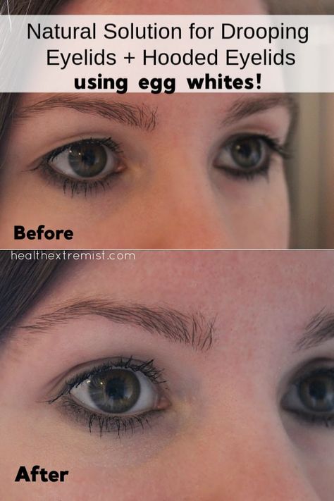 Natural Remedy For Drooping Eyelids, Sagging Eyelids or Hooded Eyes - Just apply some egg white to your upper eyelid, let it dry, and it will change how your eyelid falls! Saggy Eyelids, Drooping Eyelids, Hooded Eyelids, Droopy Eyelids, Droopy Eyes, Extra Skin, Excess Skin, Upper Eyelid, Skin Tissue