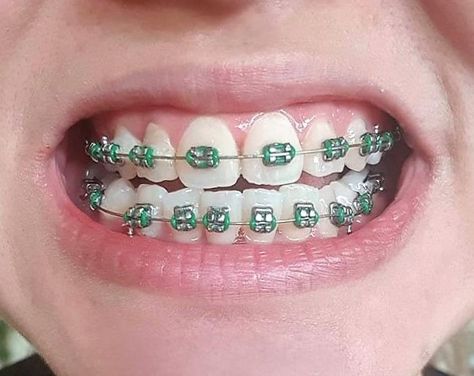 Braces Colour Ideas, Green Braces, Adult Braces, Getting Braces, Braces Colors, Orthodontics Braces, Perfect Teeth, Braces, Glow Up?