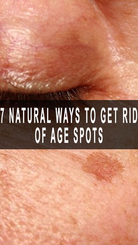 7 Natural Ways to Get Rid of Age Spots Get Rid Of Age Spots, Age Spot Remedies, Skin Firming Cream, Black Spots On Face, Get Rid Of Spots, Age Spot Removal, Extreme Cold Weather, Hydrate Your Skin, Natural Recipes