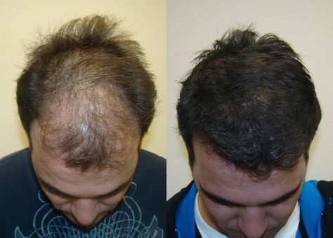 Are you looking for Hair Transplant in Chandigarh? We at Chandigarh Hair Transplantation provide you the fue hair transplant at lowest cost. Dr Rahul Goyal is the Plastic Surgeon over here with 5+ years of experience. To know the cost estimation, Whatsapp your head pictures at 9815727418. Losing Hair Women, Hair Transplant Women, Products Video, Hair Transplant Cost, Hair Transplant Results, Chest Hair, Fue Hair Transplant, Hair Transplant Surgery, Best Hair Transplant