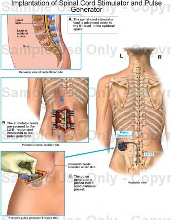 Spinal Cord Stimulator, Pain Assessment, Cauda Equina, Cardiac Disease, Spinal Fusion, Complex Regional Pain Syndrome, Spine Health, Sciatic Nerve Pain, Medical Anatomy