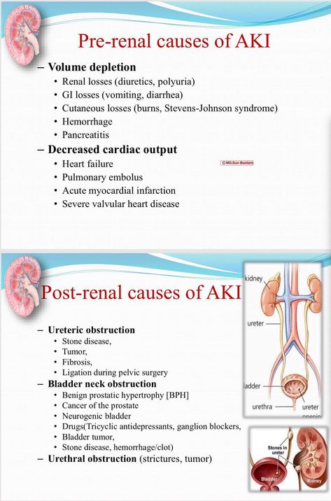 Acute Kidney Injury Kidneys Nursing, Patient Care Technician, Nursing Things, Medical Life, Acute Kidney Injury, Med Surg Nursing, Nurse Study Notes, Nursing Mnemonics, Surgical Nursing