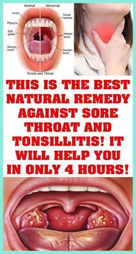 Remedies For Swollen Tonsils, Best Sore Throat Remedies, Home Remedies For Sore Throat, Swollen Tonsils, Sore Throat Remedies, Throat Remedies, For Sore Throat, Strep Throat, Canker Sore