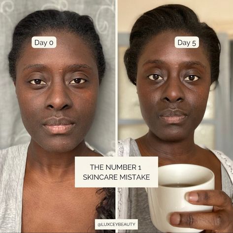 I have just documented an exceptional experience 5 days apart that reminded me of what had caused my chronic inflammation in the past as well as helped me restore hydration levels and hope that you will also help. I used to be afraid to moisturize my acne-prone skin. But I've come to realize that moisturizing is the most important anti-inflammatory action for my skin and probably for all others, provided you know how to moisturize. Dehydrated skin can become inflamed (pimples, redness and more Inflamed Pimple, Natural Asthma Remedies, Asthma Remedies, Different Skin Types, Dark Spots On Face, New Money, Beauty Rituals, Spots On Face, Face Lines