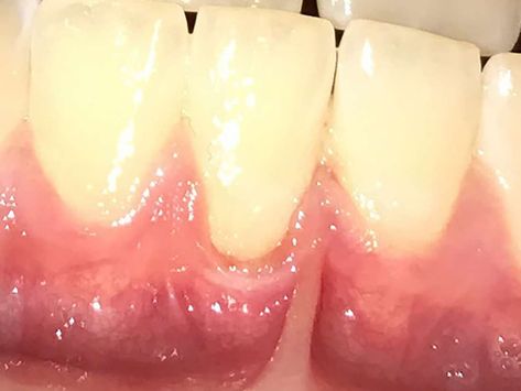 Reverse Receding Gums, Gum Graft, Grow Back Receding Gums, Gum Inflammation, Healthy Gums, Gum Recession, Teeth Health, The Teeth, Receding Gums