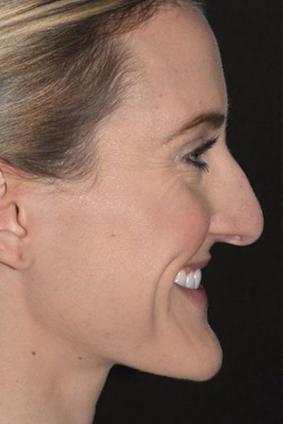 9/23/23, person unknown, age 30, photo by Roseville Facial Plastic Surgery, source: https://www.rosevillefacialplasticsurgery.com/photo-gallery/chin-augmentation/chin-augmentation-case-2/ Facial Fem Surgery, Chin Reduction Surgery, Plastic Surgery Fails, Double Chin Surgery, Chin Surgery, Kpop Plastic Surgery, Jaw Reduction Surgery, Chin Reduction, Neck Lift Surgery