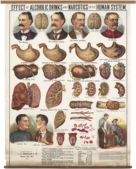 A spectacular 1910 chromolithographic poster illustrating the effects of alcohol and tobacco, issued just as the Temperance movement was nearing its apogee. Flight Medic, Temperance Movement, Effects Of Alcohol, Medical Emergency, Emergency Medicine, Advertising Ads, Antique Maps, Dark Ages, Vintage Advertising