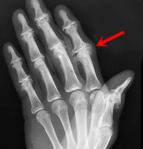 Erosive OA Types Of Fractures, Halloween Week, Human Bones, Medical Anatomy, Medical Terms, Radiology, Anatomy Art, X Ray, Sacred Geometry