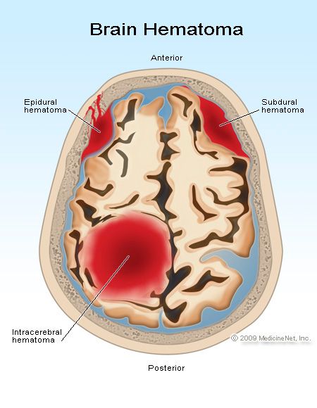 Intracranial Hemorrhage, Radiology Imaging, Brain Surgeon, Nursing Mnemonics, Brain Anatomy, Nursing School Survival, Medical School Studying, Nursing School Notes, Brain Cells