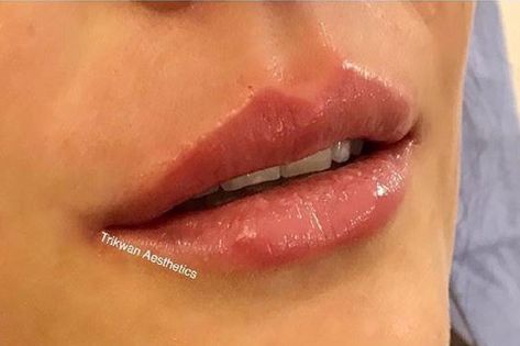 Lip Fillers Cupids Bow, Cupid Bow Lips Filler, Lip Filler Cupids Bow, Defined Cupids Bow Lips, Bow Shaped Lips, Cupid Bow Lips, Bow Lips, Cupids Bow Lips, Medical Aesthetician