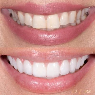 Veneer Teeth Inspiration, Veneers Before And After, Teeth Inspiration, Teeth Invisalign, Teeth Makeover, Loose Teeth, Natural Teeth Whitening Remedies, Teeth Aesthetic, Composite Veneers