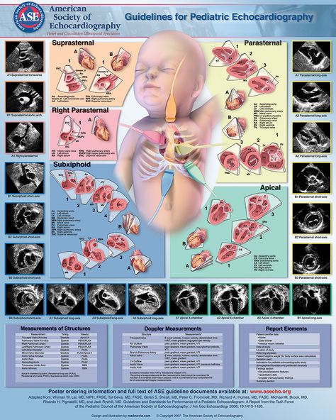 ASE_Poster4_24x30_cmyk Pediatric Echocardiography, Sonogram Technician, Ekg Leads, Cardiac Sonography, Sonography Student, Nursing School Inspiration, Ultrasound Sonography, Pediatric Medicine, Diagnostic Medical Sonography