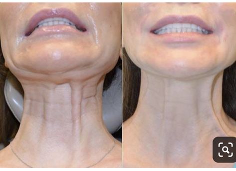 Platysmal Bands, Botox Injection Sites, Baked Catfish, Catfish Recipe, Injection Sites, Botox Injection, Botox And Fillers, Botox Before And After, Botox Lips