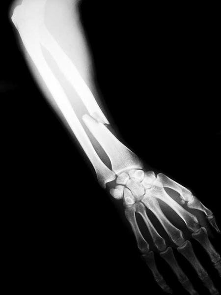 Strontium: The Forgotten Mineral For Strong Bones X-ray Images, Arm Cast, Dangerous Sports, Medical Health Care, Baby Quiet Book, Broken Arm, Friendship And Dating, Strong Bones, Mind The Gap