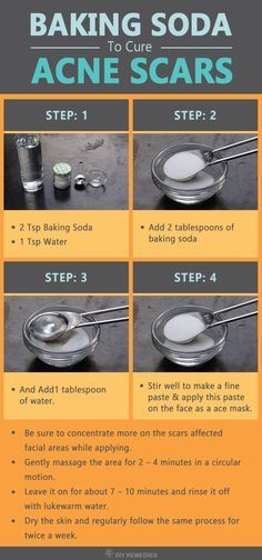 When baking soda mixed with water then it exhibit various properties that clear many skin problems, including acne scars. Baking Soda For Acne, Obličejové Masky, Rid Of Acne, Natural Acne, Acne Scar Removal, Baking Soda Shampoo, Cystic Acne, Acne Remedies, Skin Remedies