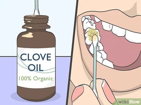 4 Ways to Use Clove Oil for Tooth Pain - wikiHow Clove Oil Benefits Teeth, Home Remedy For Tooth Infection, Essential Oils For Tooth Infection, Cloves For Tooth Pain, Natural Tooth Pain Relief, Cloves For Teeth, Clove Oil For Tooth Ache, Essential Oils For Tooth Pain, Home Remedy For Tooth Ache Pain