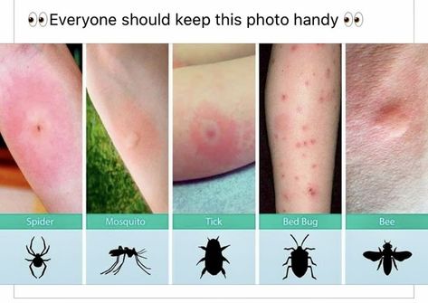 Bug bites | Useful life hacks, Identifying bug bites, Survival skills life hacks Nyttige Tips, Organizator Grafic, Survival Skills Life Hacks, Survival Life Hacks, Bug Bites, Teen Life Hacks, Survival Life, Everyday Hacks, Amazing Life Hacks