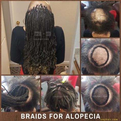 Braids for Alopecia Crochet Braids For Alopecia, Braids For Alopecia For Black Women, Braids For Alopecia, Alopecia Braid Styles, Individual Box Braids, Dread Ideas, Cornrows Updo, Miracle Workers, Alopecia Hairstyles