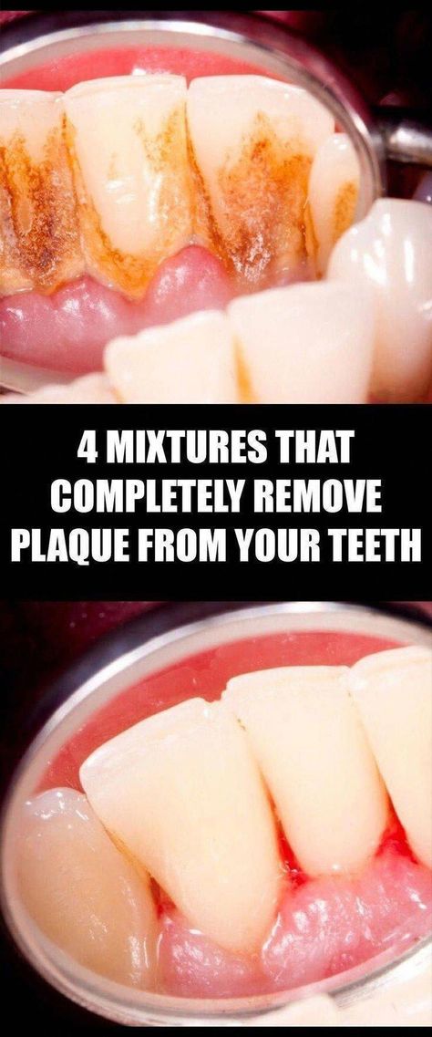 4 Mixtures That Completely Remove Plaque From Your Teeth #OralHealth #GoodOralHe..., #Completely #GoodOralHe #Mixtures #oralhealth #Plaque #REMOVE #Teeth #OralHealthCareAdvice #WhatIsAnOralHealthCarePlan #WhatDoesOralCareMean #WhoDefinitionOfOralCare #BestOralCareAdvice #PreventiveOralHealthCare Reverse Cavities, Tooth Decay Remedies, Remedies For Tooth Ache, Coconut Oil For Teeth, Dental Health Care, Oral Care Routine, Gum Care, Oral Health Care, Tooth Decay