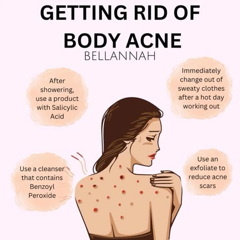 Getting Rid Of Body Acne How To Get Rid Of Face Acne, How To Rid Of Acne, Acne On Back How To Get Rid, How To Get Rid Of Body Acne Fast, How To Actually Get Rid Of Acne, Get Rid Of Back Acne Fast, How To Get Rid Of Back Acne Naturally, How To Get Rid Of Scars On Face From Acne, Different Types Of Acne How To Get Rid