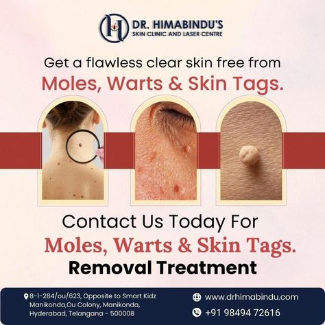 Skin Tags Removal, Modern Clinic, Warts Removal, Remove Skin Tags Naturally, Remove Warts, Mole Removal, Healthy Lifestyle Quotes, Skin Tags, Botox Injections