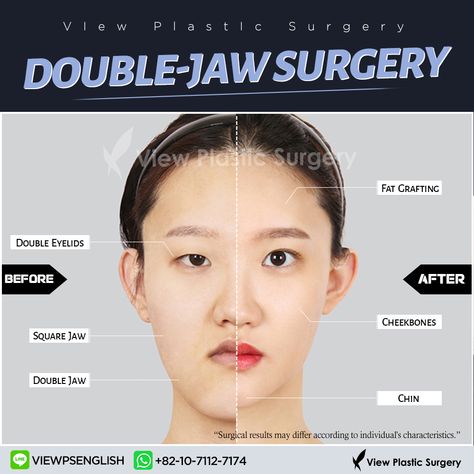 Complete transformation at View Plastic Surgery! Double jaw surgery brought the main changes by fixing protruding lower jaw! Chin, cheekbones, and square jaw were reduced to make the face slimmer! Double eyelid surgery made her eyes look bigger and awake. And the final touch is creating a more youthful and refined appearance with Fat Graft. Consult us for your Beauty 💕: - Whatsapp: +82 10 7112 7174 - KakaoTalk Plus Friend: viewpsenglish - Line: viewpsenglish - Email: eng_viewps@viewclinic.com Bigger Eyes Surgery, Protruding Chin, Chin Surgery, Square Jaw, Double Jaw Surgery, Face Slimmer, Bigger Eyes, Face Surgery, Facial Bones