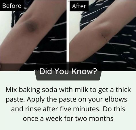 Dark elbow remedy Dark Knees And Elbows, Dark Knees, Facial Tips, Skin Face Mask, Natural Skin Care Remedies, Natural Face Skin Care, Good Skin Tips, Basic Skin Care Routine, Healthy Advice