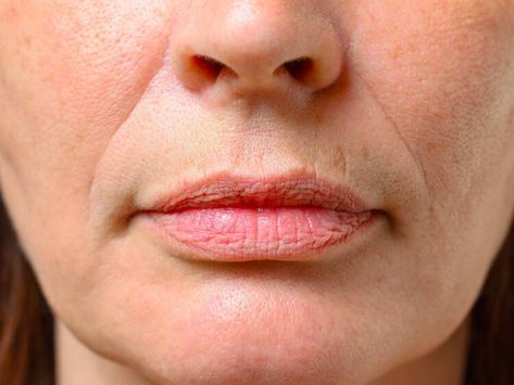 Wrinkles around mouth and lips- Dermatologist approved facial care. | Anna S. | NewsBreak Original Wrinkles Around Mouth, Age Makeup, Old Age Makeup, Smokers Lines, Mouth Wrinkles, Corrective Makeup, Hyaluronic Acid Fillers, Lip Wrinkles, Nasolabial Folds