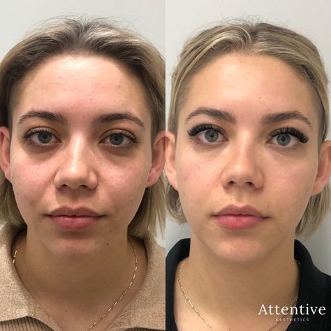 Under Eye Fillers Perth | Tear Trough Filler Perth | Attentive Aesthetics | Cosmetic Clinic Perth Tear Through Eye Filler, Tear Trough Filler, Under Eye Filler, Tear Trough Filler Before After, Eye Dermal, Under Eye Hollows, Under Eye Fillers, Tear Trough, Cheek Fillers