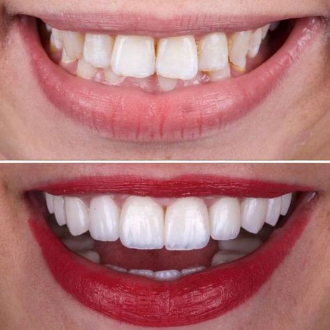 How I Healed My Teeth Naturally: Dental Secret To Rebuild Gums, Get Rid of Tooth Decay and Cavities.#toothdecay,#toothproblem,#dentist,#receding,#OralHygieneCare,#WhatAreOralCare,#WhatIsOralCare,#HowToCareForOralHealth,#OralDentalCare,#teeth #HealthTips #SelfCare #NutritionTips #FitLife #Wellness #HealthyLiving #FitnessTips #HealthyLifestyle Emax Veneers, Grow Back Receding Gums, Whiten Teeth Fast, I Healed, Tooth Decay Remedies, Teeth Whitening Homemade, Veneers Teeth, Teeth Whitening Remedies, Grills Teeth