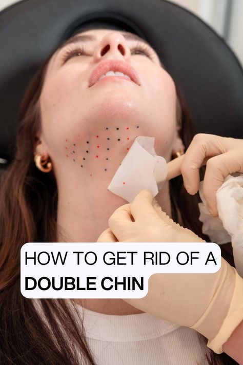 No chin waddle with here with Kybella! Kybella contains synthetic deoxycholic acid, which breaks down fat cells under the chin, enhancing facial contours non-surgically. After a few days of swelling, you can expect some snatched results! Kybella Before And After, Double Chin, Facial, Quick Saves