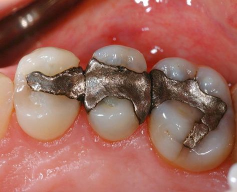 Why do I need a crown and not just a filling? – The Dental Sherpa Amalgam Fillings, Tooth Filling, Cell Phone Radiation, Dental Fillings, Disease Symptoms, Shocking Facts, Alternative Health, Healthy Teeth, Health Conditions