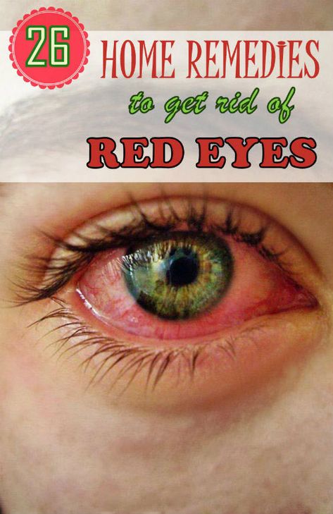 Home Remedy Hacks — 26 Effective Home Remedies to Get Rid of Red Eyes Tiredness Remedies, Eye Stye Remedies, Toenail Fungus Remedies, Allergic Rhinitis, Sleep Remedies, Holistic Remedies, Natural Home Remedies, Eye Health, Natural Medicine