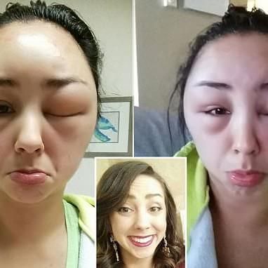 Woman documents scary allergic reaction to HAIR DYE in dramatic images Hair Dye Allergy, Dramatic Images, What A Girl Wants, Allergic Reaction, Girl Needs, Skin Conditions, Hair Dye, Dyed Hair, Allergies