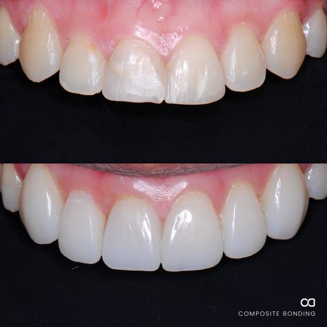 Composite Edge Bonding Teeth, Cosmetic Bonding Teeth, Composite Bonding Teeth Before And After, Dental Bonding Before And After, Composite Bonding Before And After, Composite Veneers Before And After, Teeth Bonding Before And After, Esthetic Procedures, Composite Bonding Teeth