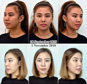 How To Get Rid Of Face Fat Chubby Cheeks, Voluma Cheeks Before And After, Face Fat Loss Before And After, Buccal Fat Removal, Full Cheeks, Cheek Fat, Corrective Jaw Surgery, Ancient Chinese Dress, Wide Face