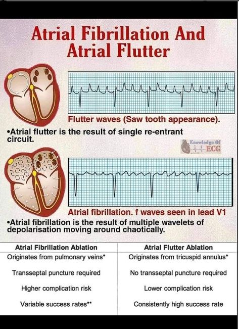 atrialflutter, atrialfibrillation Atrial Fibrillation And Flutter, Ekg Reading, Heart Physiology, Paramedic Study, General Medicine, Medical Life, Nurse Study, Medical Notes, Medical School Life