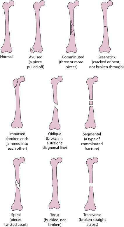 Some Types of Fractures Rad Tech Student Notes, Fracture Types, Types Of Poison, Medical Diagrams, Rad Tech Student, Types Of Injuries, Types Of Fractures, Medical Terminology Study, Medical Things