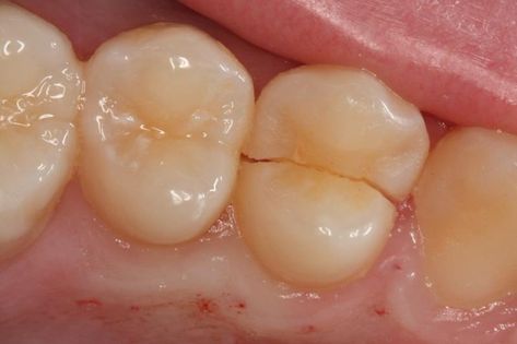 Cracked teeth, what will happen with future lasers where we can scan and repair cracked pathogens Cracked Tooth, Tooth Infection, Dental Bonding, Dental Fillings, Dental Emergency, Teeth Implants, Dental Procedures, Gum Health, Best Dentist