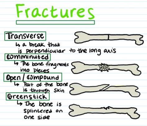 Fracture Types | Medical school inspiration, Nursing school notes, Medical school essentials Vtne Study Notes, Nursing Notes Aesthetic, Adn Nursing, Medical Assistant Student, Medical Notes, Nursing School Essential, Nursing School Motivation, Nurse Study Notes, Nursing Student Tips