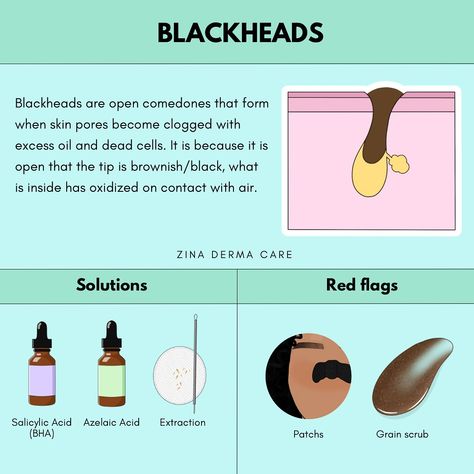 🖤 BLACKHEADS 101🖤 Did you know that blackheads are open comedones that occur when your skin pores get clogged with excess oil and dead skin cells? The reason for their characteristic brownish/black tip is that the contents oxidize upon contact with air! ✨ Solutions to Say Goodbye to Blackheads Salicylic Acid: A powerful BHA that penetrates pores to clear out debris. Azelaic Acid: Helps to exfoliate and reduce inflammation. Extraction: Professional removal for a fresh start! 🚫 Red Flags to... Salicylic Acid Benefits, Clear Skin Routine, Get Rid Of Blackheads, Azelaic Acid, Acne Care, Skin Pores, Red Flags, A Fresh Start, To Say Goodbye